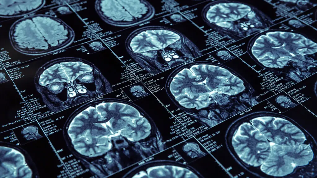Alzheimer's disease on MRI film