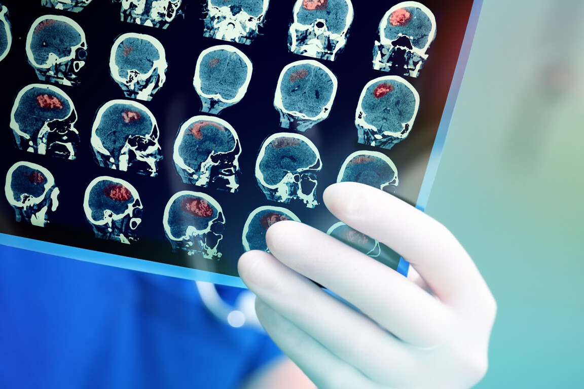 Rapid genomic test to speed up brain tumour diagnosis