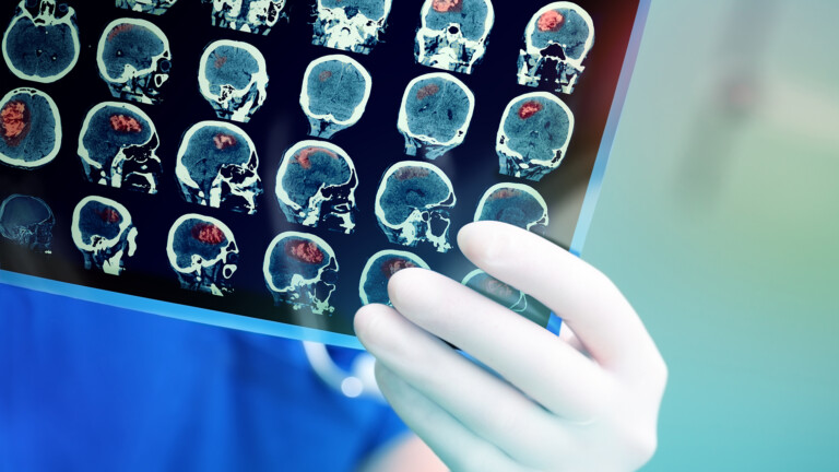 Rapid genomic test to speed up brain tumour diagnosis