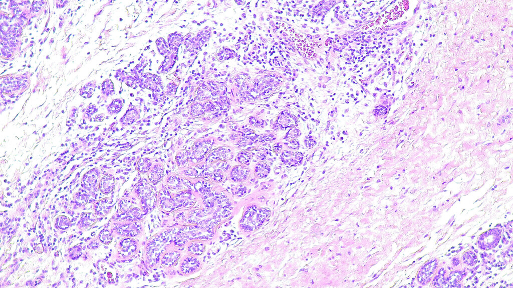 Human cervical cell tissue under a microscope in a pathology lab