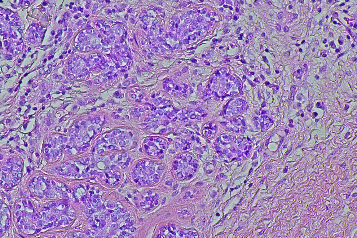 Human cervical cell tissue under a microscope in a pathology lab