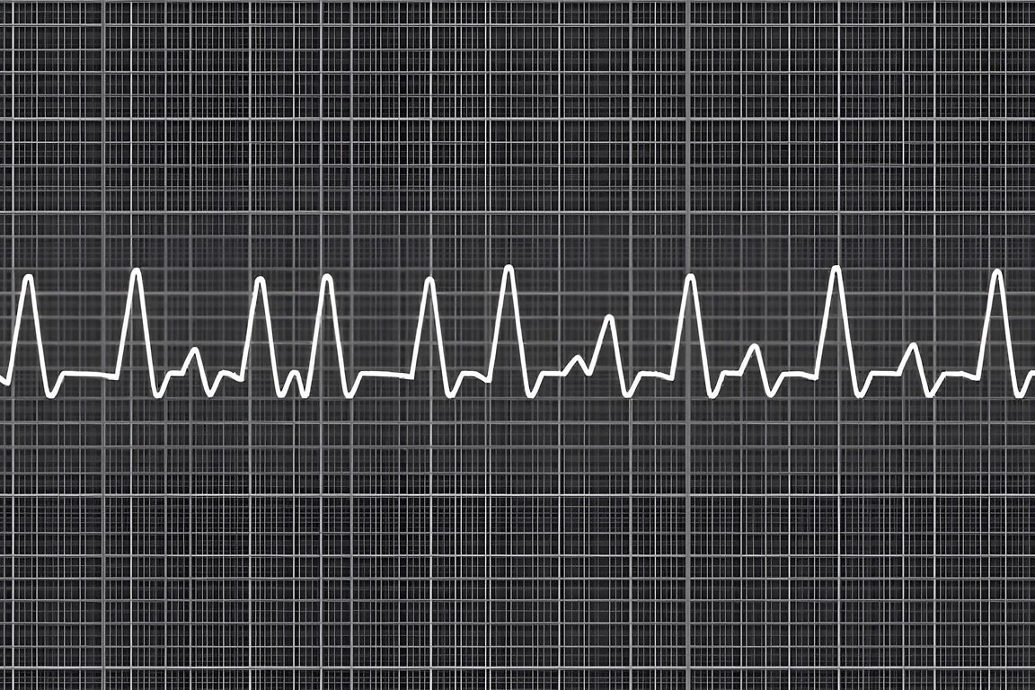 ECG example of a pathological 12-lead rhythm, Fallot's tetralogy