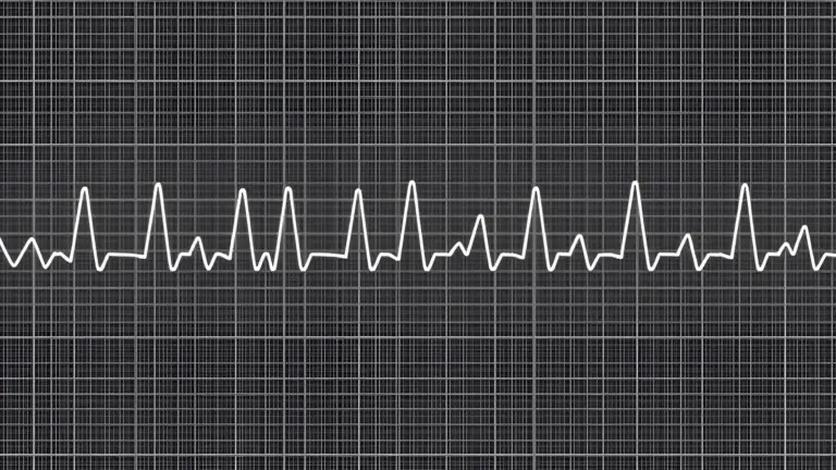 ECG example of a pathological 12-lead rhythm, Fallot's tetralogy