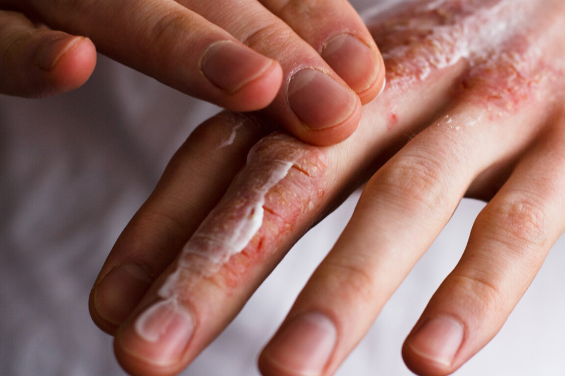 Ichthyosis Awareness Month