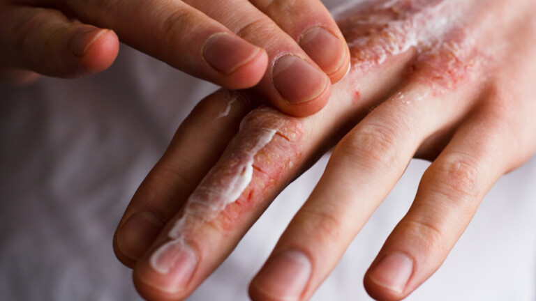 Ichthyosis Awareness Month