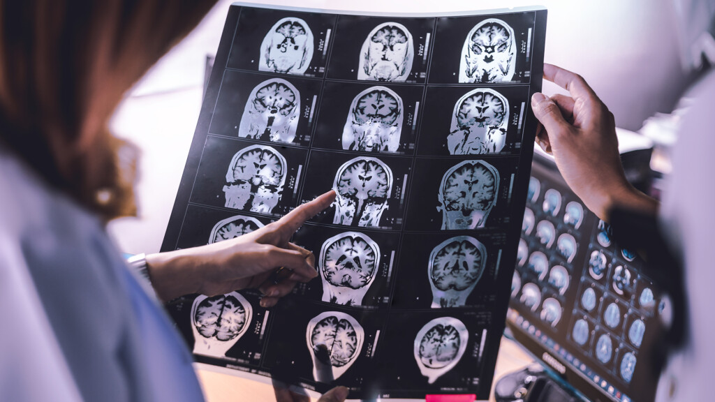MRI of Dementia patient