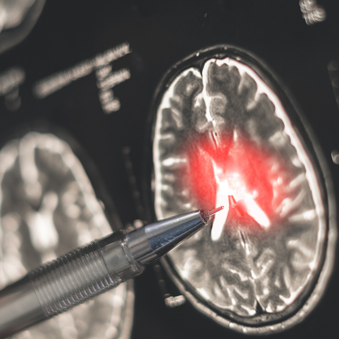 £80 million challenge launched to speed up dementia diagnosis