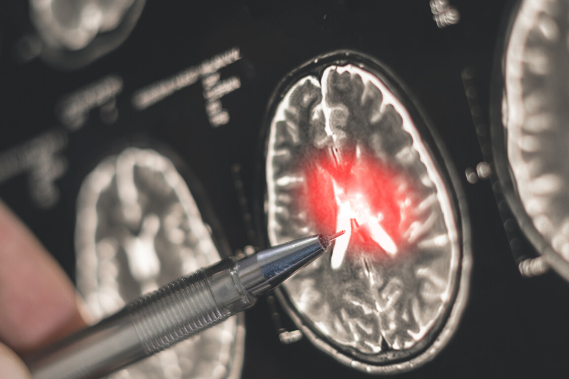 £80 million challenge launched to speed up dementia diagnosis