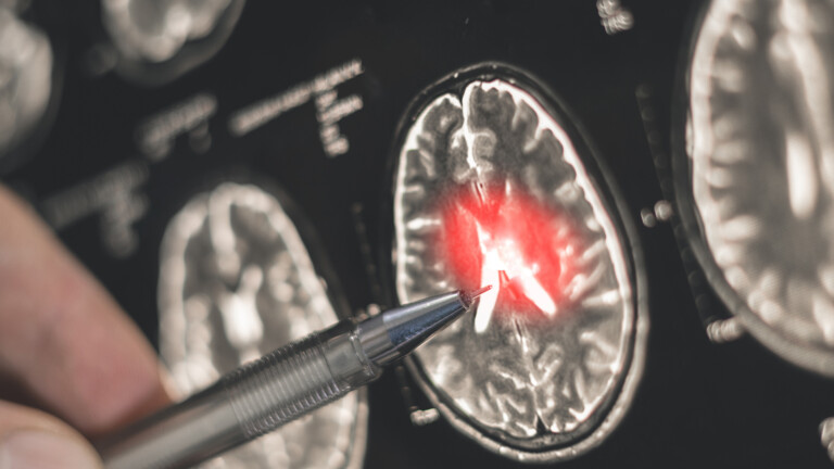 £80 million challenge launched to speed up dementia diagnosis
