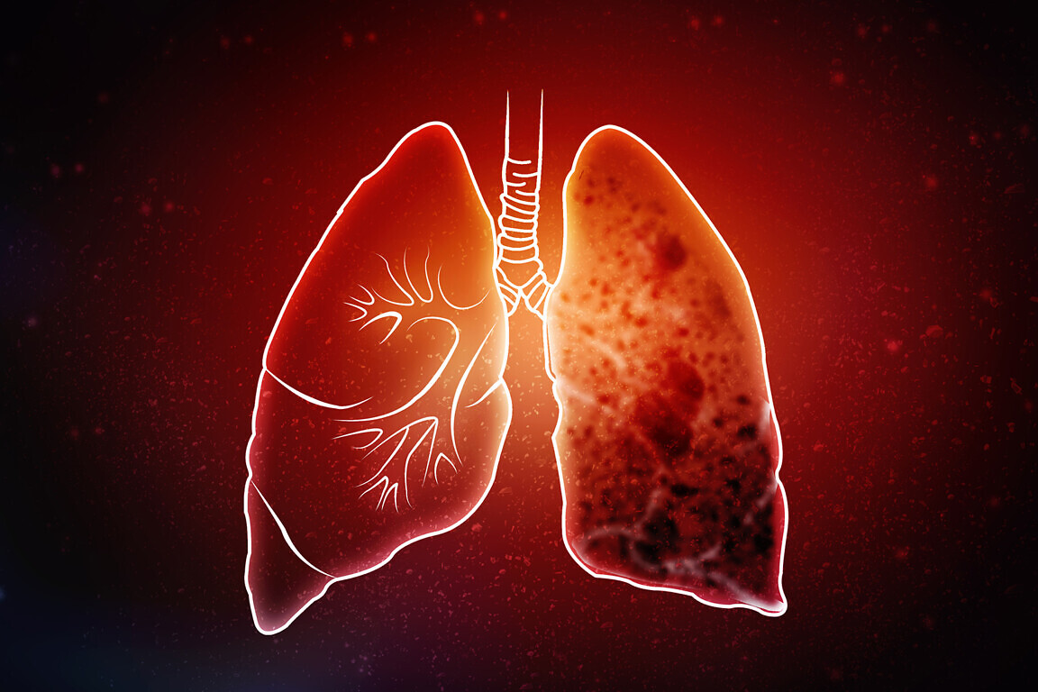 Tuberculosis
