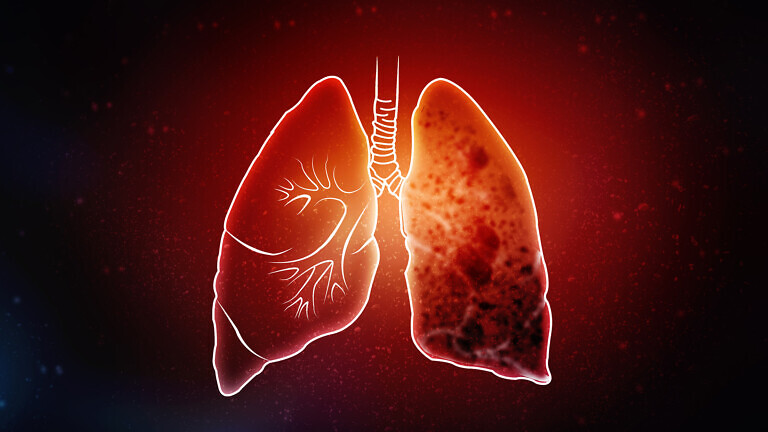 Tuberculosis