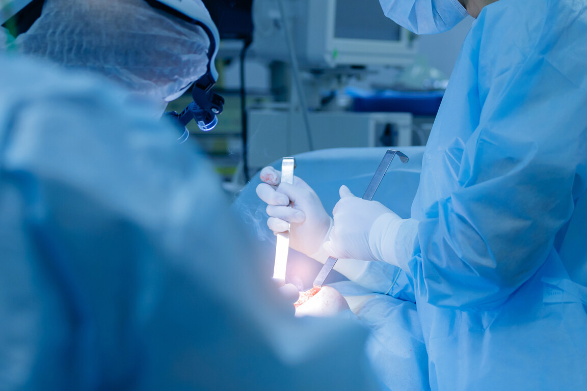 Surgical team performing umbilical hernia removal.