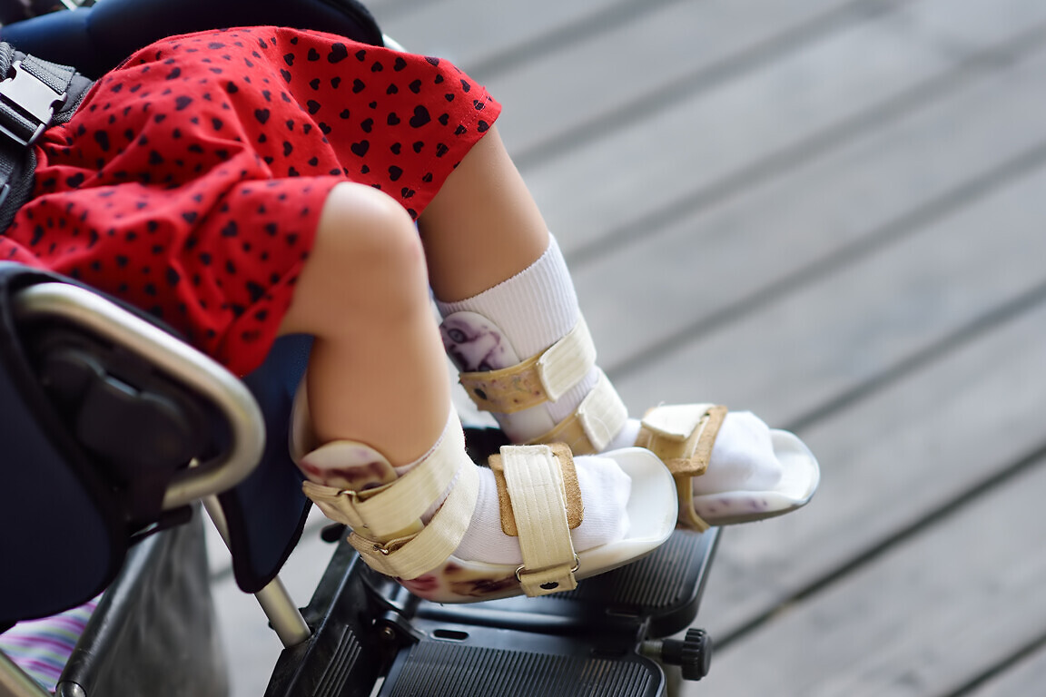 Disabled girl sitting in wheelchair. On her legs orthosis. Child cerebral palsy. Inclusion. Family with disabled kid.