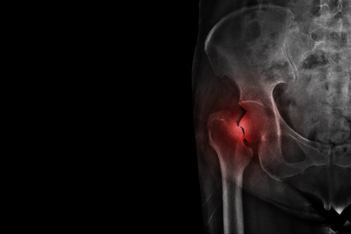 Film X ray hip radiograph show broken hip bone