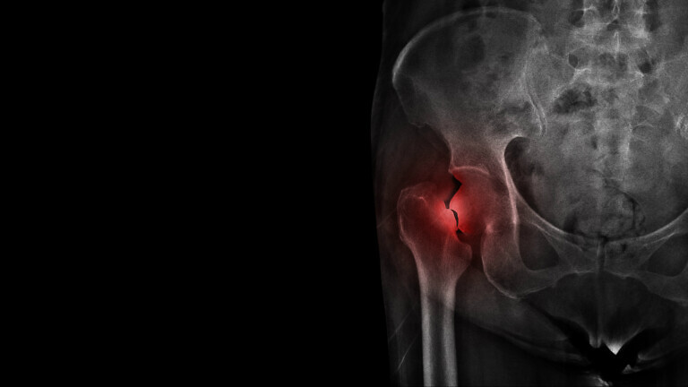 Film X ray hip radiograph show broken hip bone