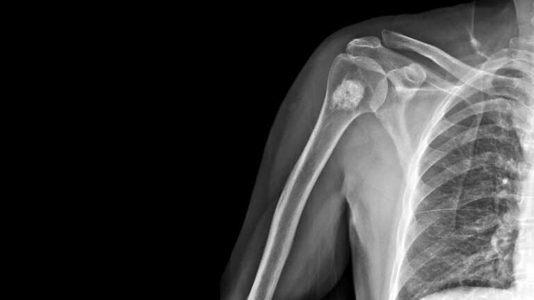 Musculoskeletal health