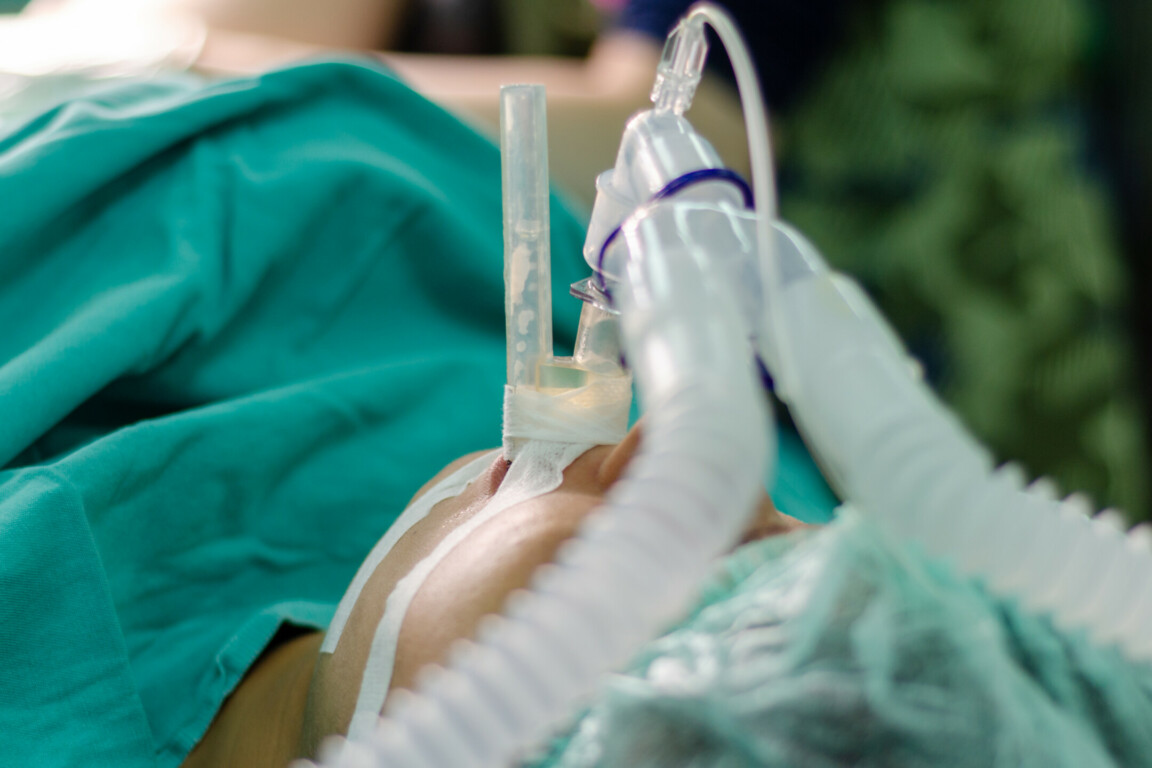 Breathing tube intubation