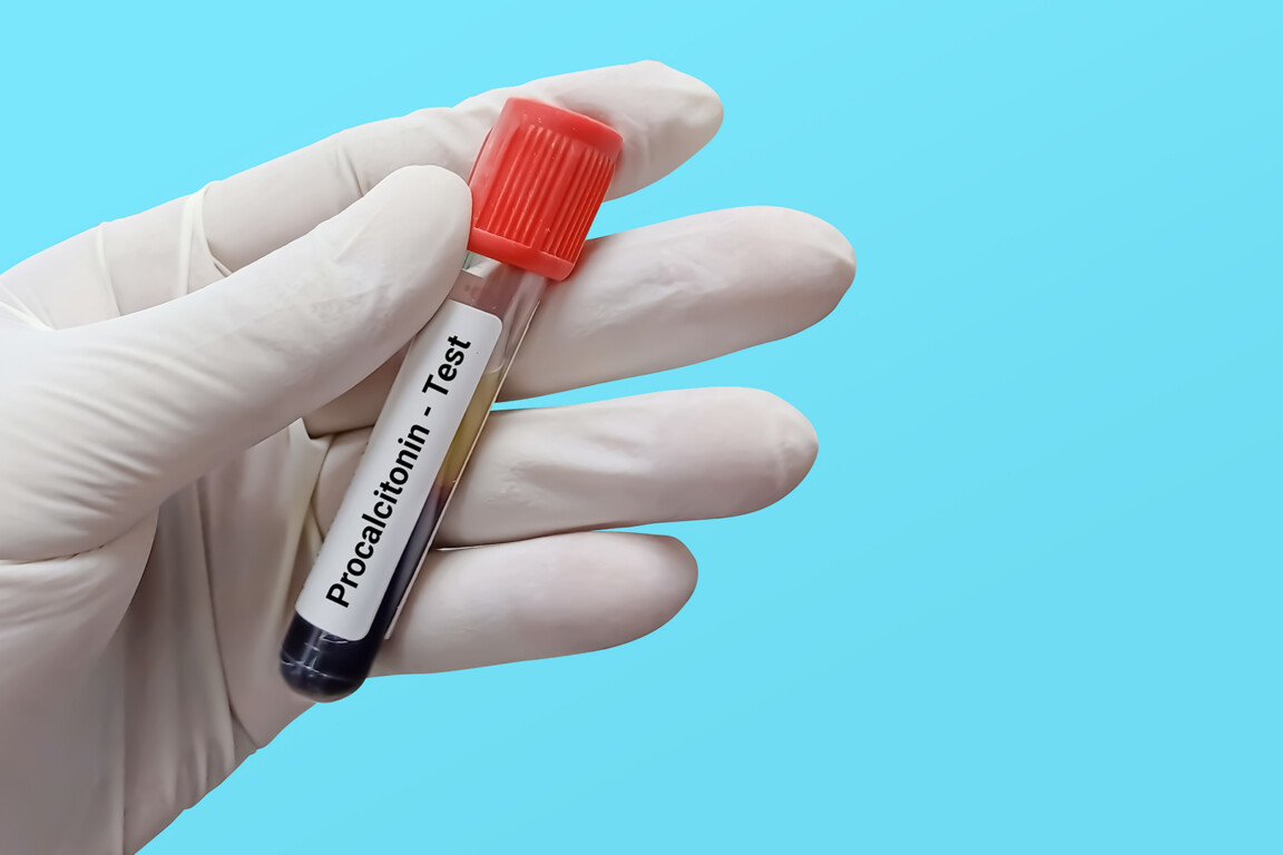 Blood sample for Procalcitonin