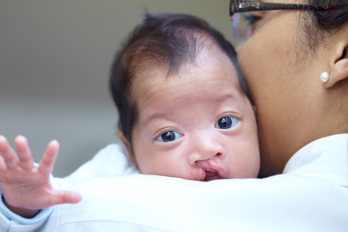 Portrait of a baby girl who has a cleft palate looking over the shoulder of her mother.