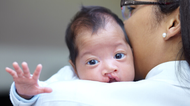 Portrait of a baby girl who has a cleft palate looking over the shoulder of her mother.