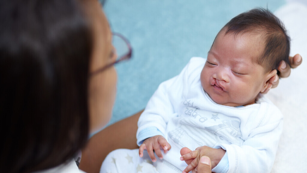 Shot of a sleeping baby girl with a cleft palate being held by her mother.