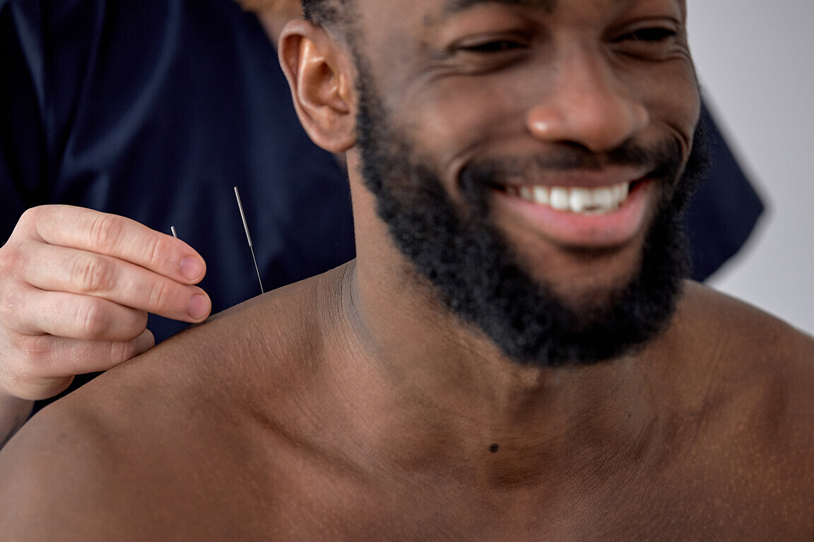 Acupuncture