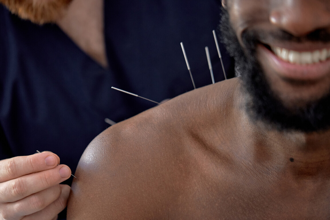 Acupuncture