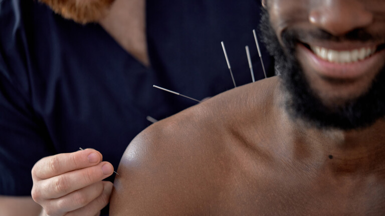 Acupuncture