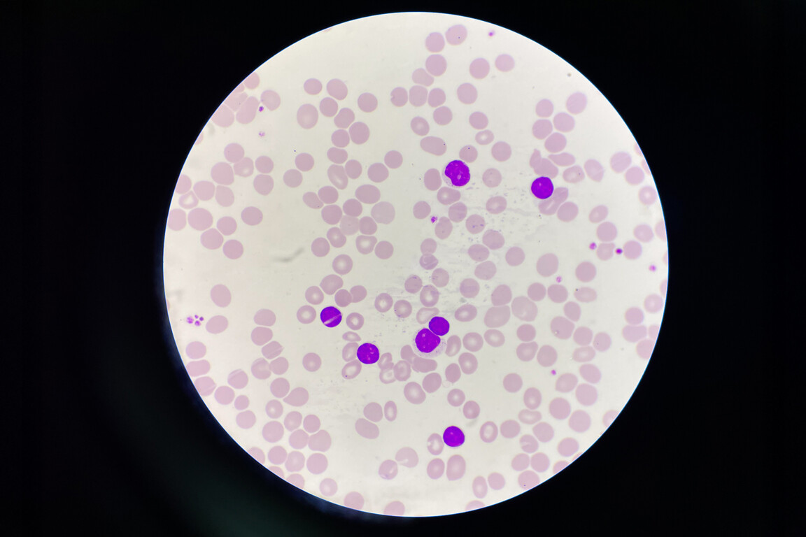 Chronic lymphocytic leukemia.