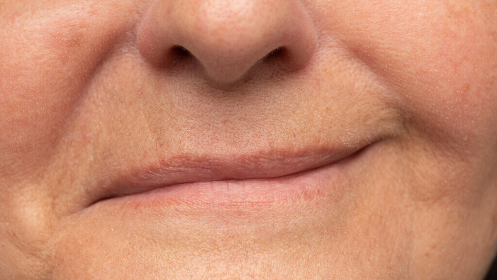 facial asymmetry due to facial paralysis