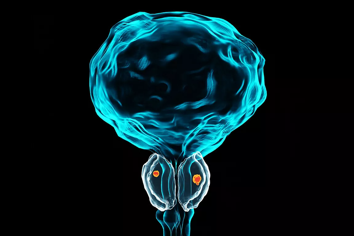 Prostate cancer stages. ancerous cells, malignant tumor compress