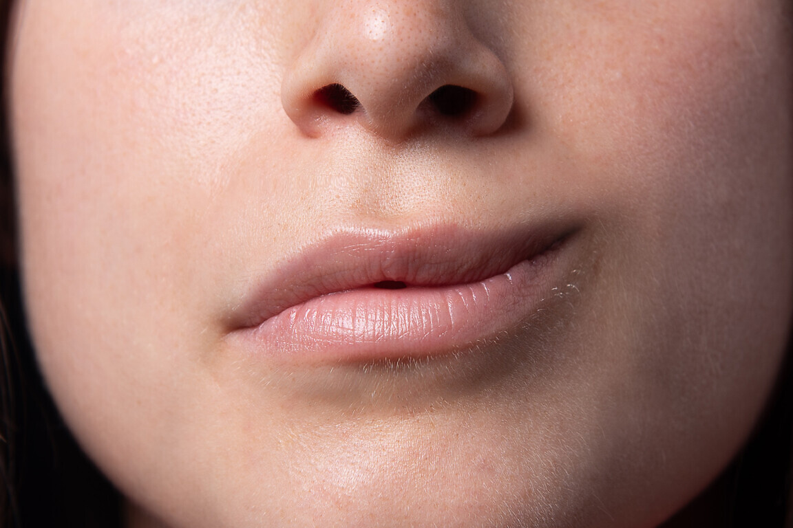 facial asymmetry due to facial paralysis