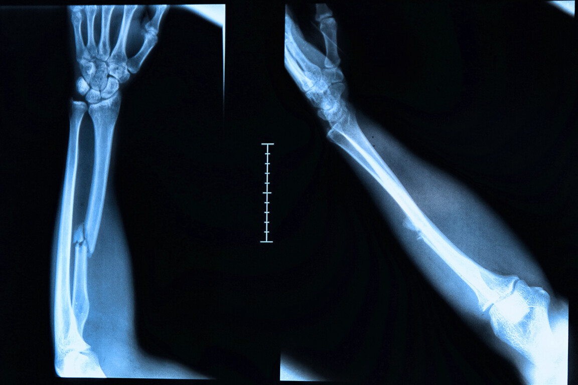 Arm fracture seen on x-ray