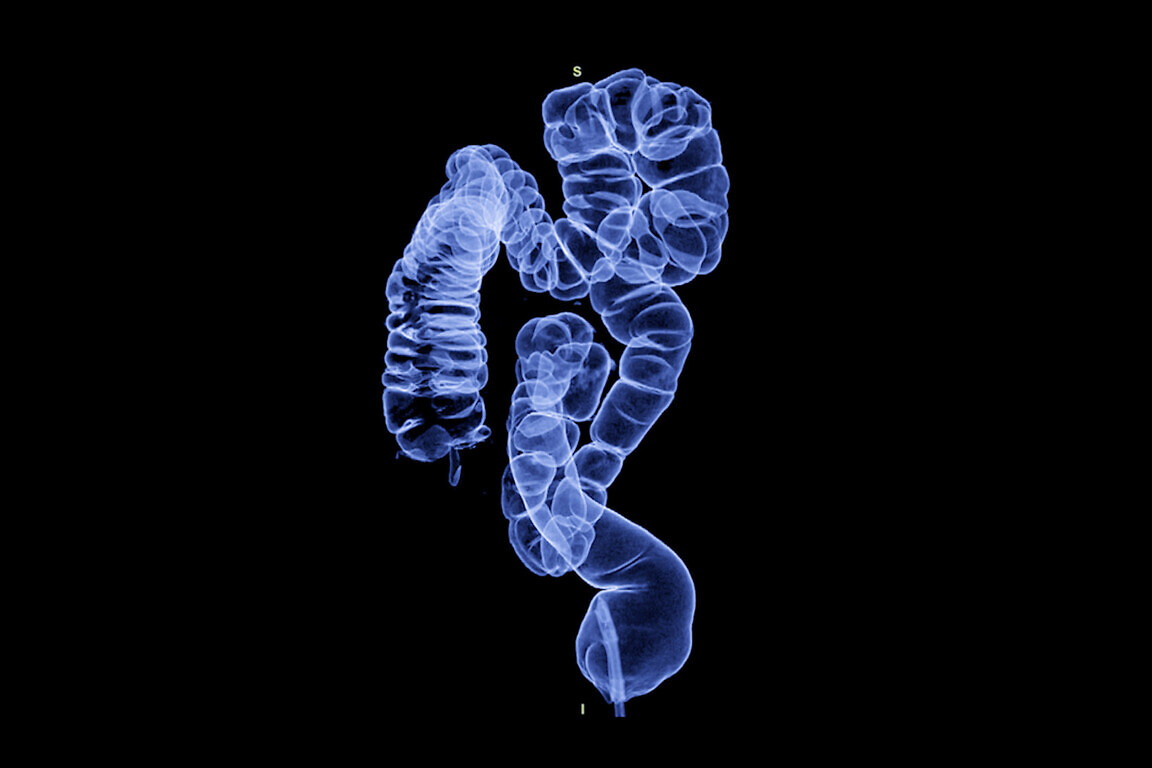 CT colonography , This imaging technique is often employed for c