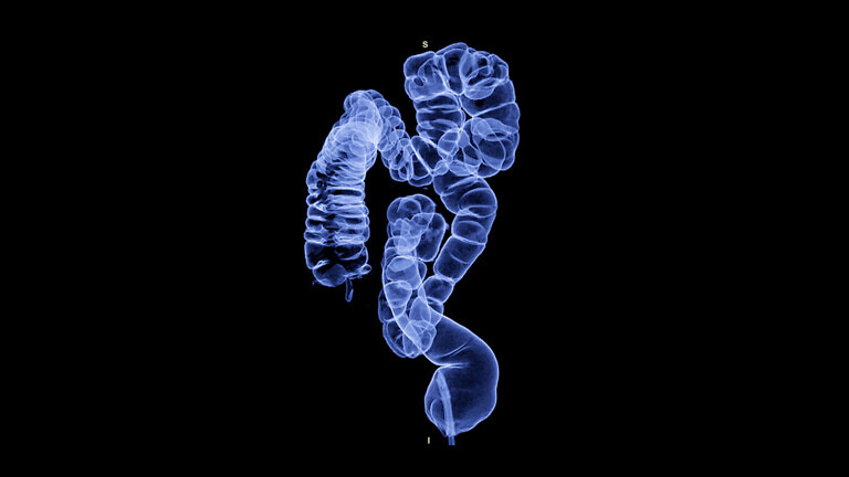 CT colonography , This imaging technique is often employed for c