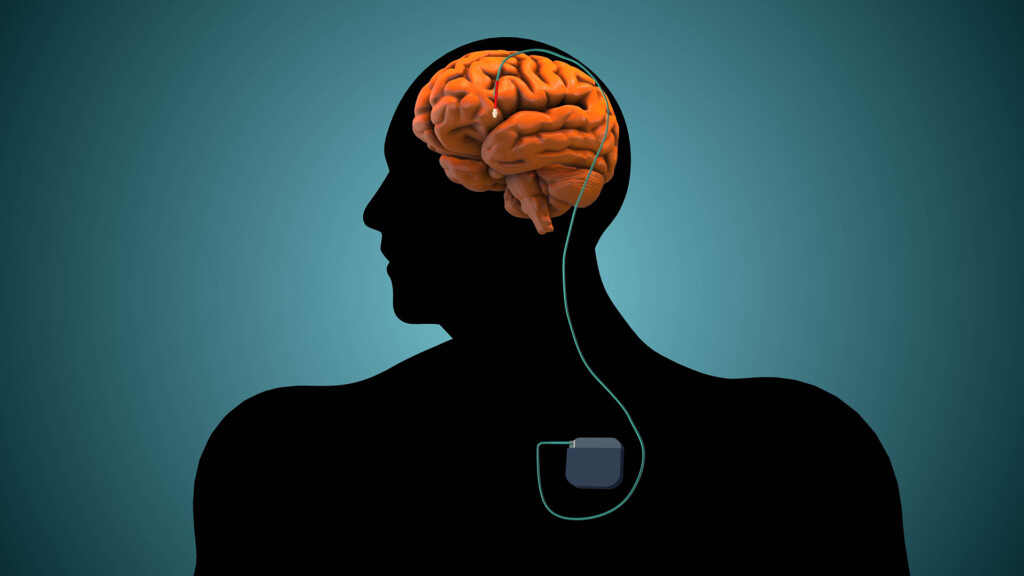Deep brain stimulation