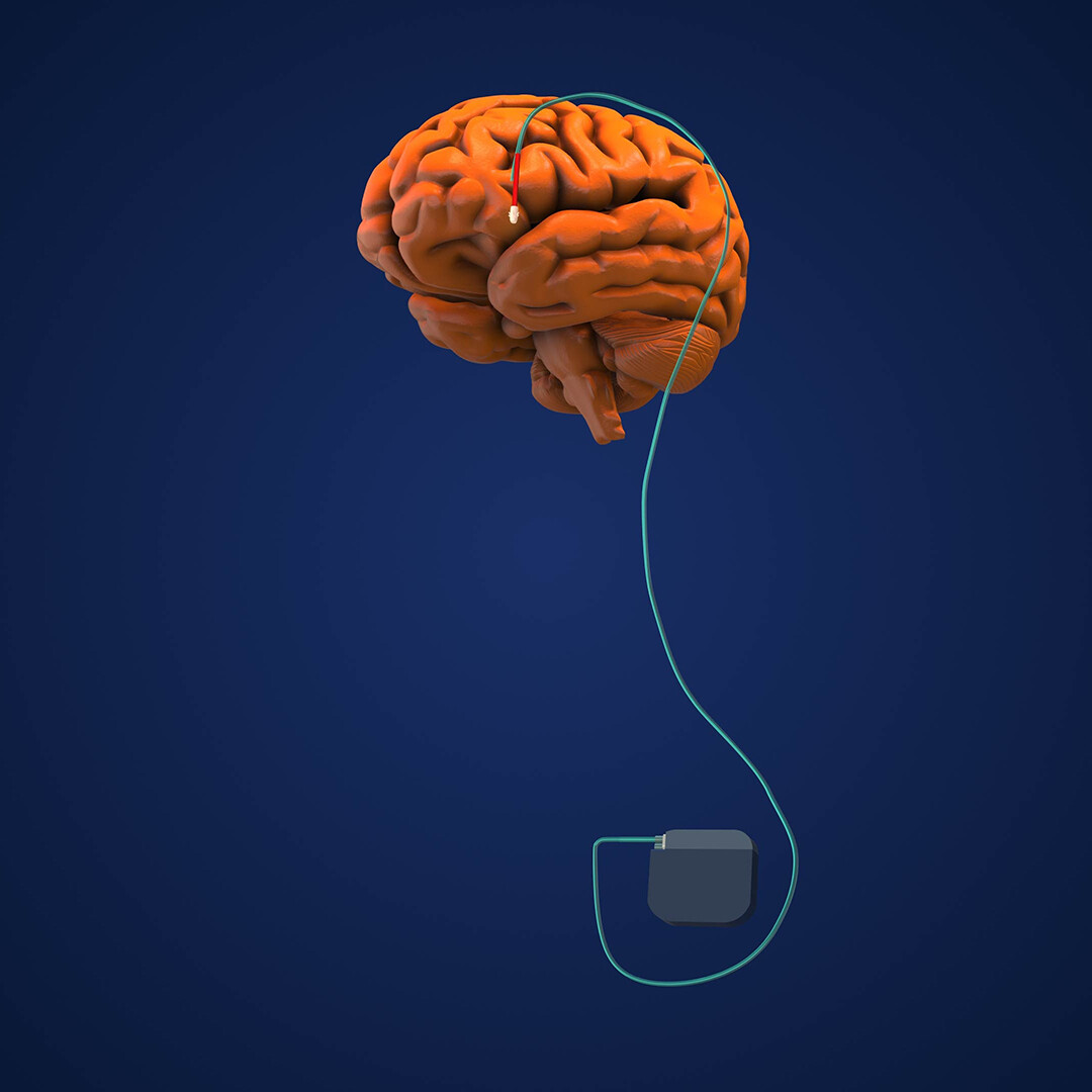 Deep brain stimulation