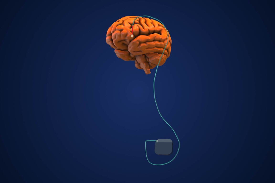 Deep brain stimulation