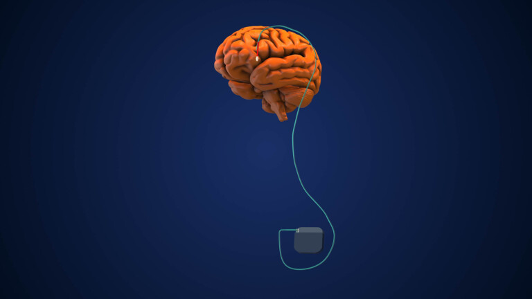 Deep brain stimulation