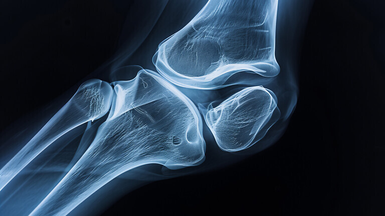 X-ray of a knee joint showing ligaments and bone alignment