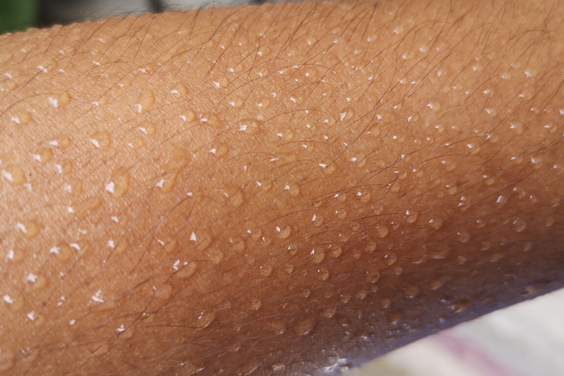 Primary axillary hyperhidrosis (PAHH)