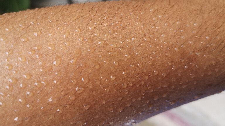 Primary axillary hyperhidrosis (PAHH)