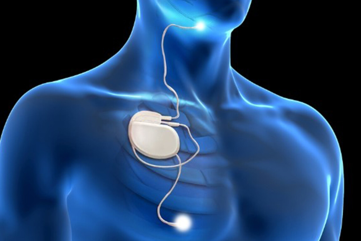 Hypoglossal nerve stimulation