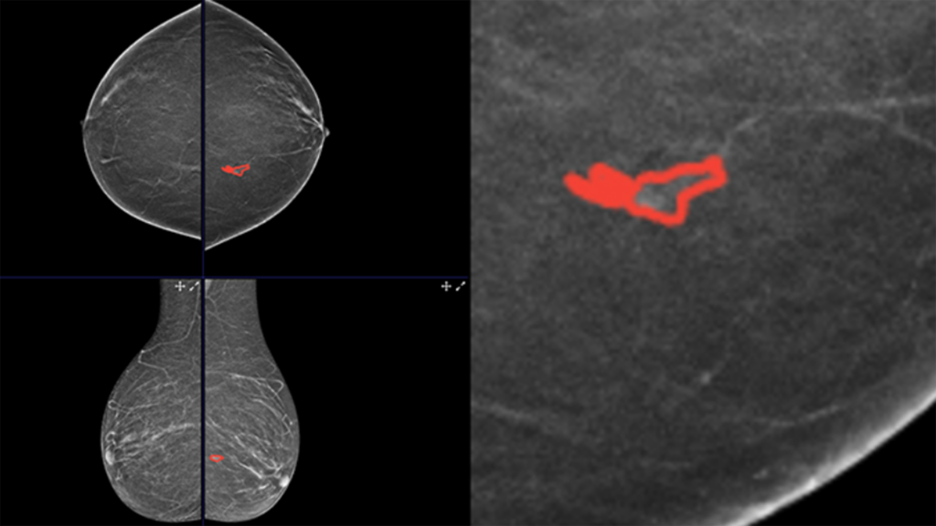 Free annotated 3D mammography data set to advance AI research in breast cancer detection.